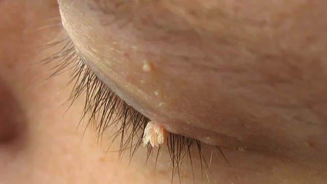 Filiform Warts: Pictures, Treatment, and More