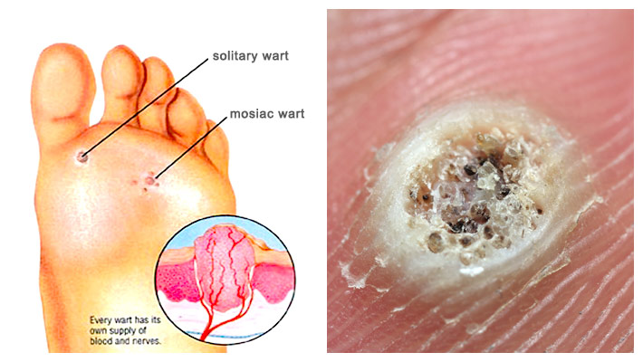 Warts - Chicago Foot Care Clinic