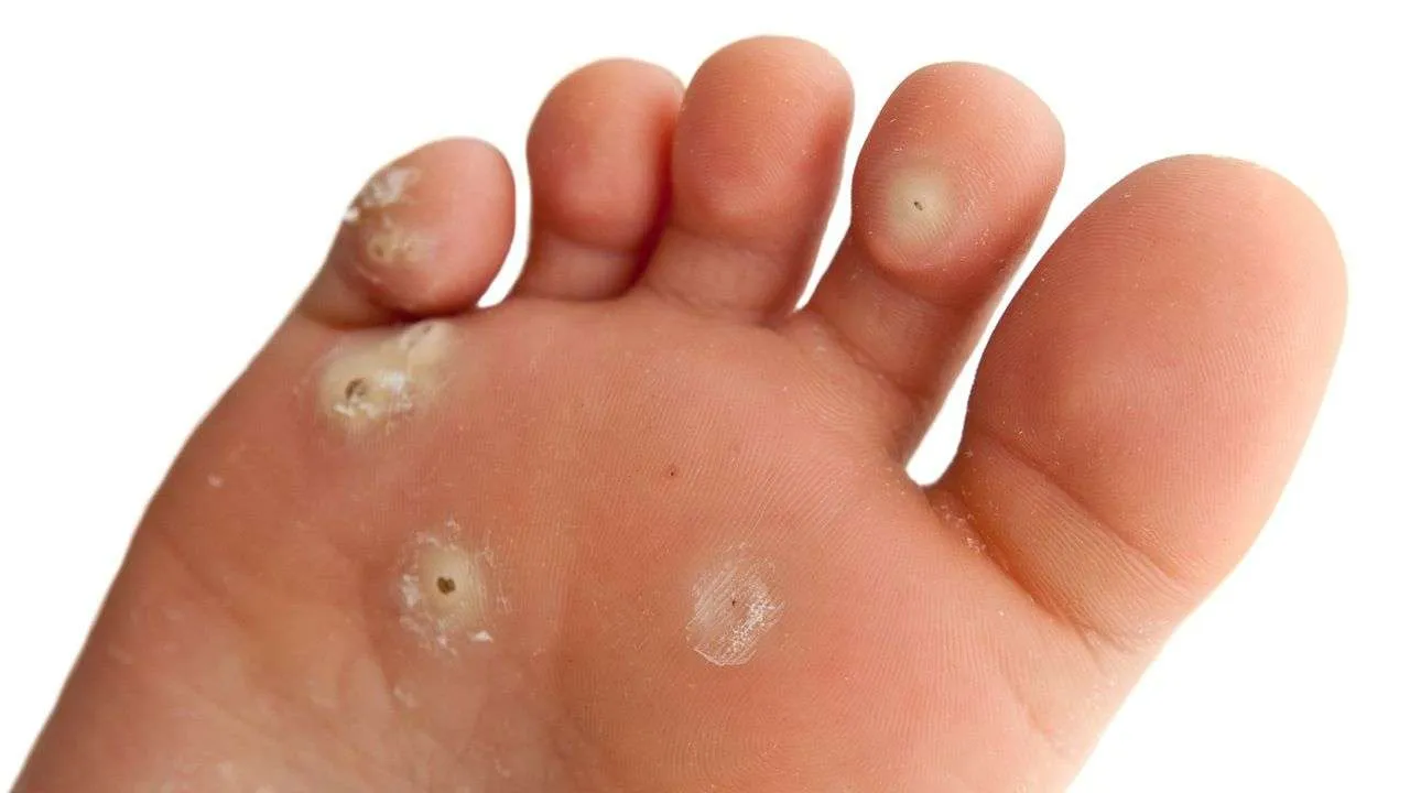 Plantar Wart Removal | Causes & Treatments | YTFCS